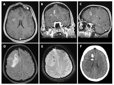 Polymorphous low-grade neuroepithelial tumor of the young with FGFR3-TACC3 fusion mimicking high-grade glioma: case report and series of high-grade correlates